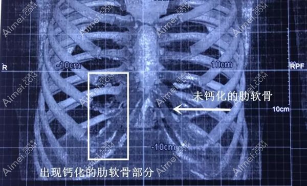 胸部CT片看软骨是否钙化.jpg 胸部CT片看软骨是否钙化.jpg