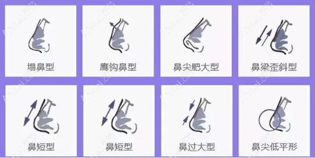上海叶怀挺医生做鼻综合优势.jpg
