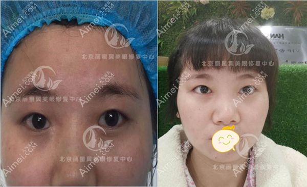 全切双眼皮改单眼皮术后1个月效果.jpg