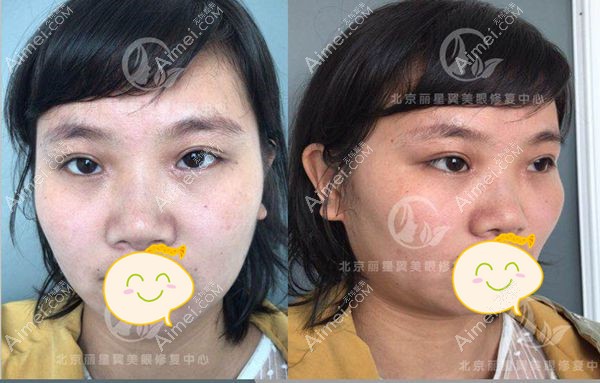 全切双眼皮失败后改单眼皮术前照片.jpg