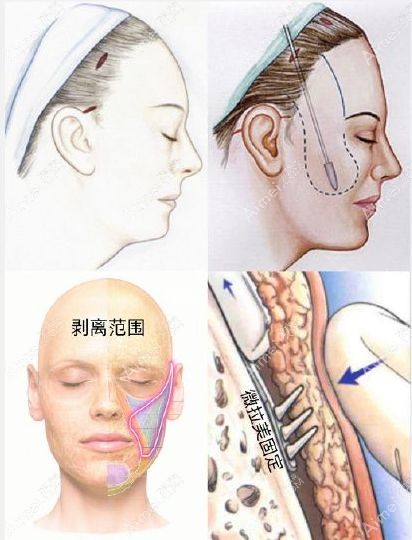微拉美面部提升手术过程.jpg 微拉美面部提升手术过程.jpg