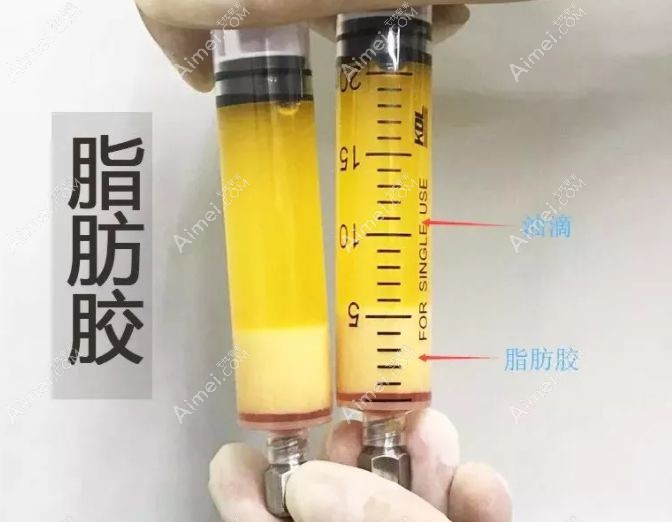 脂肪胶填充泪沟前制备后的<span style=