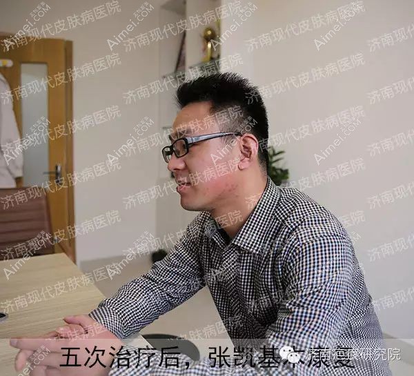济南现代皮肤病医院的abr消融重建祛疤2年后效果.jpg 济南现代皮肤病医院的abr消融重建祛疤2年后效果.jpg