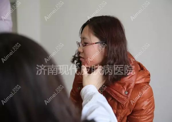 李娅主任检查疤友面部烧伤疤痕增生情况.jpg 李娅主任检查疤友面部烧伤疤痕增生情况.jpg