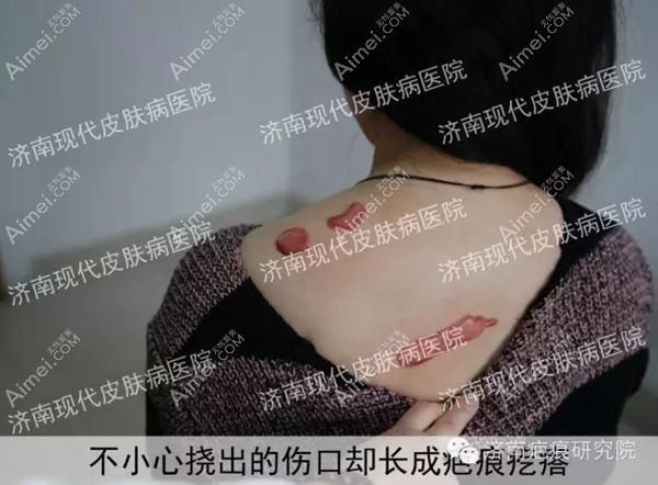 20年的疤痕疙瘩增生来济南现代皮肤病医院治疗前情况.jpg 20年的疤痕疙瘩增生来济南现代皮肤病医院治疗前情况.jpg