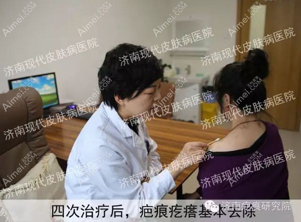 背上的增生疤痕疙瘩经过4次治疗已经平整,基本看不到了.jpg 背上的增生疤痕疙瘩经过4次治疗已经平整,基本看不到了.jpg