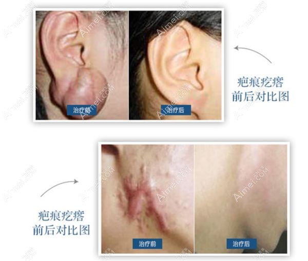 李娅医生治疗疤痕疙瘩的术前术后对比效果图.jpg 李娅医生治疗疤痕疙瘩的术前术后对比效果图.jpg
