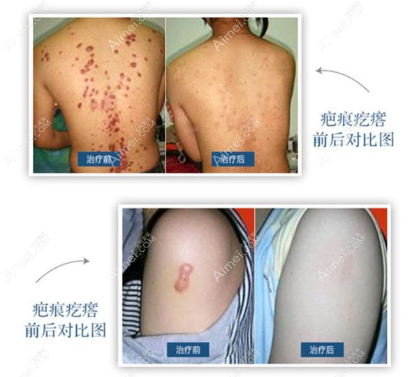 疤友来济南现代皮肤病医院治疗疤痕疙瘩的对比照.jpg 疤友来济南现代皮肤病医院治疗疤痕疙瘩的对比照.jpg