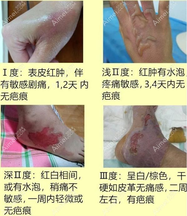 一度、浅二度、深二度、三度的烧烫疤痕情况.jpg 一度、浅二度、深二度、三度的烧烫疤痕情况.jpg