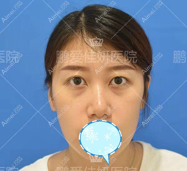 烟台鹏爱佳妍内切去眼袋术前照片.jpg 烟台鹏爱佳妍内切去眼袋术前照片.jpg