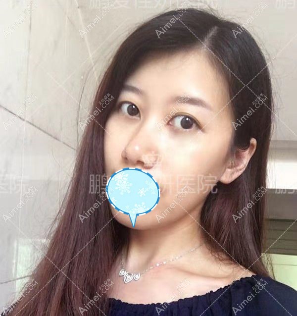 烟台鹏爱佳妍内切去眼袋术后28天恢复照片.jpg 烟台鹏爱佳妍内切去眼袋术后28天恢复照片.jpg