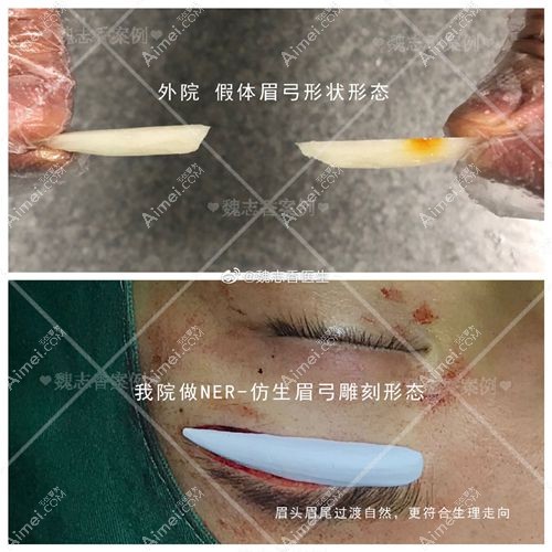 魏志香医生隆眉弓的眉头和眉尾假体过度自然.jpg 魏志香医生隆眉弓的眉头和眉尾假体过度自然.jpg