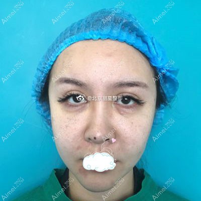 来北京丽星翼美做膨体垫眉弓术前照片.jpg