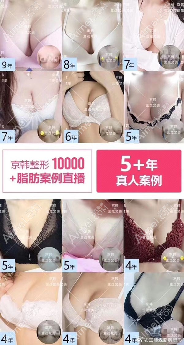 北京京韩的自体脂肪隆胸模特.jpg 北京京韩的自体脂肪隆胸模特.jpg