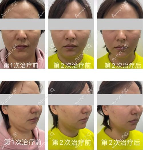 赛诺龙5gmax治疗两次的前后对比图.jpg 赛诺龙5gmax治疗两次的前后对比图.jpg