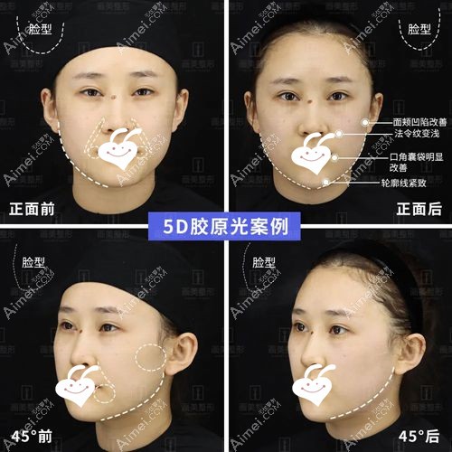 赛诺秀5d胶原光治疗前后对比图.jpg 赛诺秀5d胶原光治疗前后对比图.jpg
