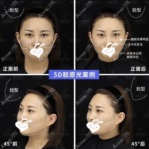 赛诺秀5d胶原光治疗前后对比图.jpg 赛诺秀5d胶原光治疗前后对比图.jpg