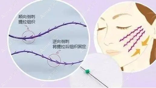 面部埋线提升后会出现皮下疤痕后遗症.jpg 面部埋线提升后会出现皮下疤痕后遗症.jpg