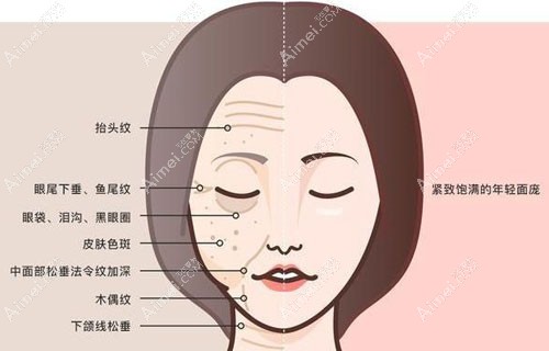 fotona4d面部提升做一次就有成效吗？操作时间多长才算正规？