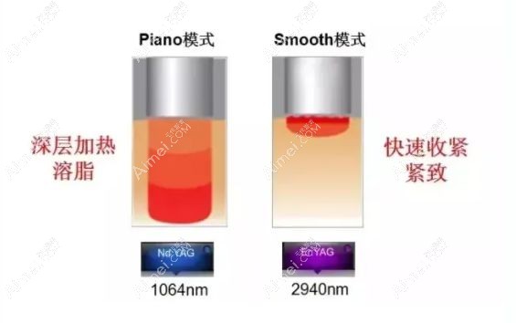fotona4d面部提升能量加热不同.jpg fotona4d面部提升能量加热不同.jpg