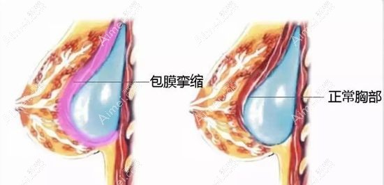 假体隆胸10后出现包膜挛缩.jpg 假体隆胸10后出现包膜挛缩.jpg