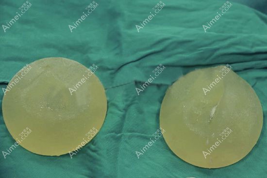 240cc的隆胸假体取出后的真实照片.jpg 240cc的隆胸假体取出后的真实照片.jpg