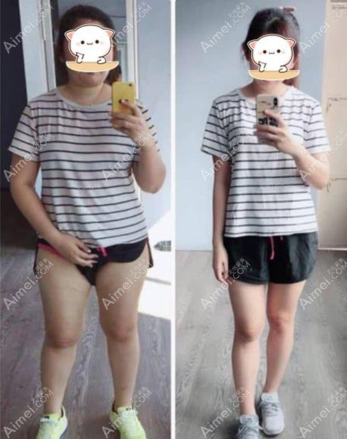 160斤胖妞吸脂手术真人图片,肚子皮肤没有松懈 160斤胖妞吸脂手术真人图片,肚子皮肤没有松懈