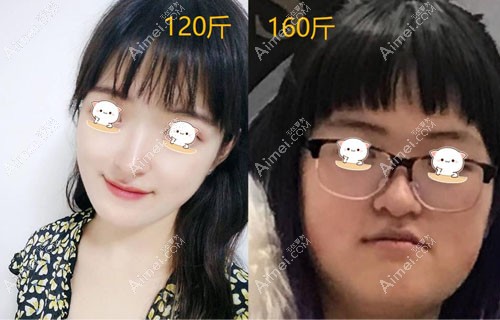对比图看面部吸脂没有导致皮肤松弛和凹凸不平 对比图看面部吸脂没有导致皮肤松弛和凹凸不平