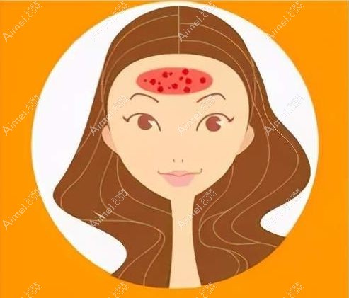 去额头皱纹的副作用之一还有额头感染.jpg 去额头皱纹的副作用之一还有额头感染.jpg