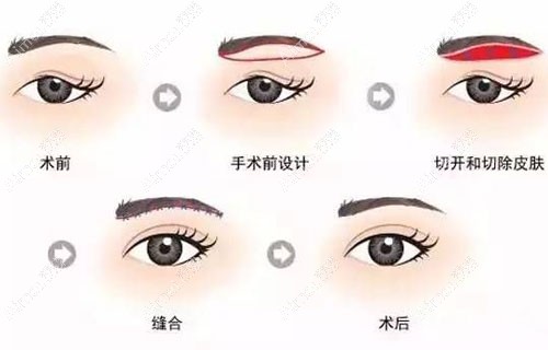 单眼皮割双眼皮10年后的对比图片，会有眼睛下垂的危害吗？