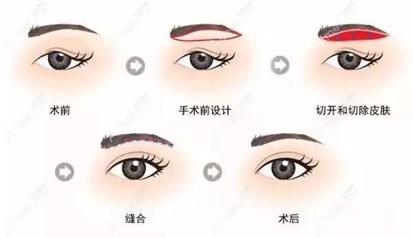 割双眼皮10年后眼皮下垂做提眉手术可改善.jpg 割双眼皮10年后眼皮下垂做提眉手术可改善.jpg