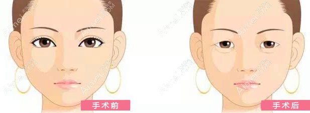 单眼皮割双眼皮10年后的对比示意图.jpg 单眼皮割双眼皮10年后的对比示意图.jpg