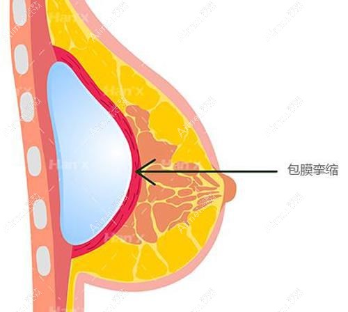 分析包膜挛缩产生主要原因.jpg 分析包膜挛缩产生主要原因.jpg
