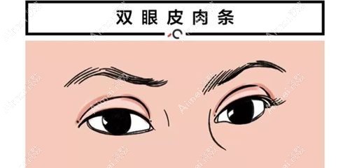双眼皮肉条眼属于眼睛做坏了.jpg 双眼皮肉条眼属于眼睛做坏了.jpg