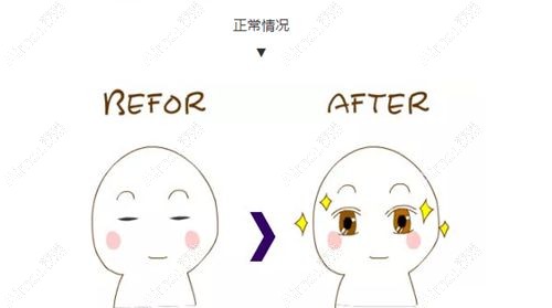 割双眼皮手术正常的术前术后对比.jpg 割双眼皮手术正常的术前术后对比.jpg