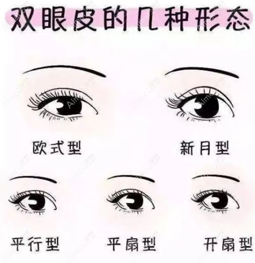 割双眼皮失败之一是弧度不流畅.jpg 割双眼皮失败之一是弧度不流畅.jpg