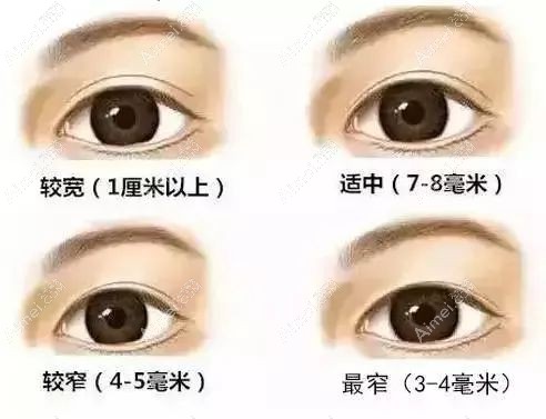 切开双眼皮失败其一是宽窄不自然.jpg 切开双眼皮失败其一是宽窄不自然.jpg