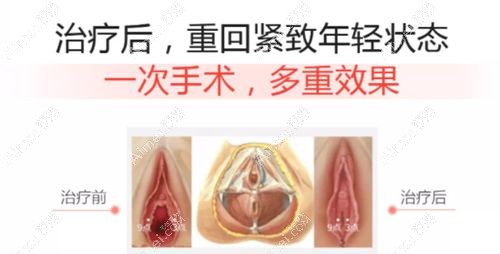 做完一次3d生物束带阴道紧缩术的对比示意图.jpg 做完一次3d生物束带阴道紧缩术的对比示意图.jpg