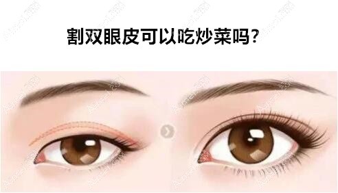 割双眼皮可以吃炒菜吗 割双眼皮可以吃炒菜吗