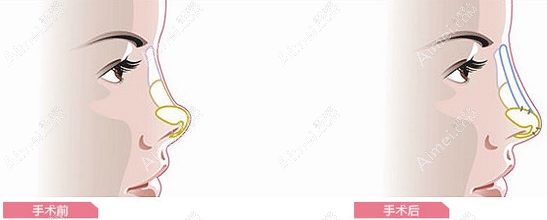 假体隆鼻示意图 假体隆鼻示意图