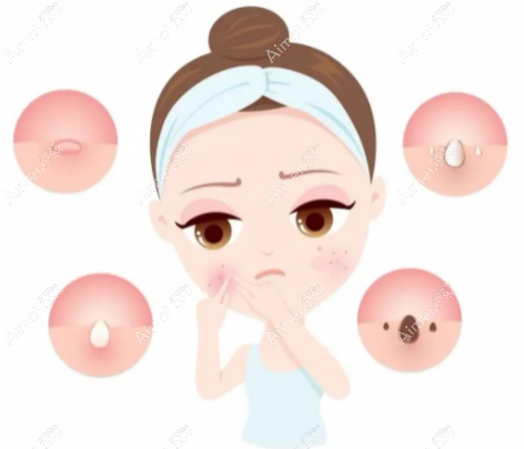 怎么安全祛痘呢？看看这些快速祛痘有效的好方法如何消除