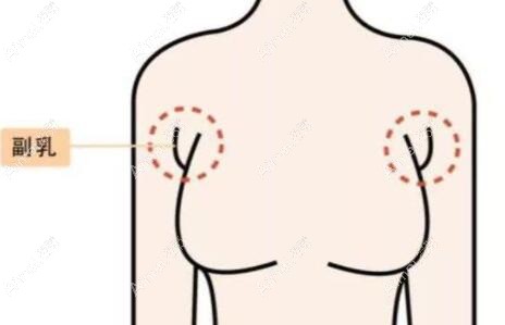产后副乳怎么消除才正确有效?副乳切除手术是微创还是开刀