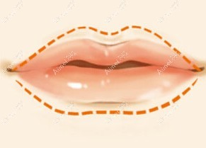 玻尿酸丰唇后起泡了怎么办？我就是起小水泡了它还渗水