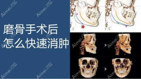 磨骨手术后面部快速消肿三大方法,看磨骨后吃什么快速消肿