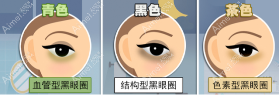 黑眼圈的几种类型 黑眼圈的几种类型