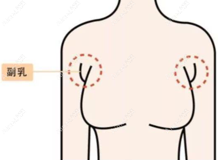 腋下副乳图示 腋下副乳图示
