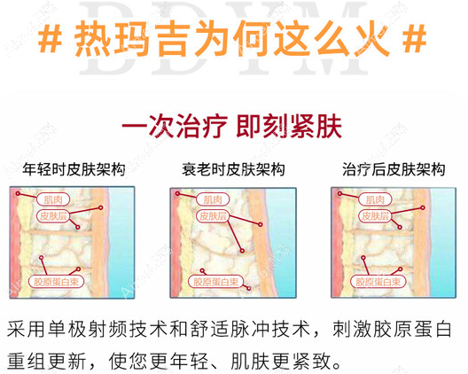 从热玛吉的治疗原理中我们能看出热玛吉是无法祛斑的 从热玛吉的治疗原理中我们能看出热玛吉是无法祛斑的