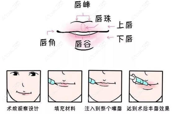 玻尿酸丰唇手术 玻尿酸丰唇手术