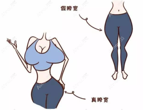 假胯宽是脂肪凸出,真胯宽是胯骨凸出 假胯宽是脂肪凸出,真胯宽是胯骨凸出