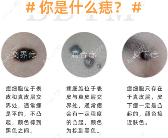 用什么方法才能快速把黑痣去掉,淡化痣的小妙招你值得拥有